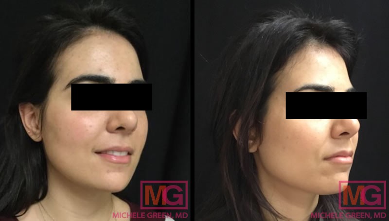 35 year old treated with Botox injections (Forehead, Glabella & Crows feet)